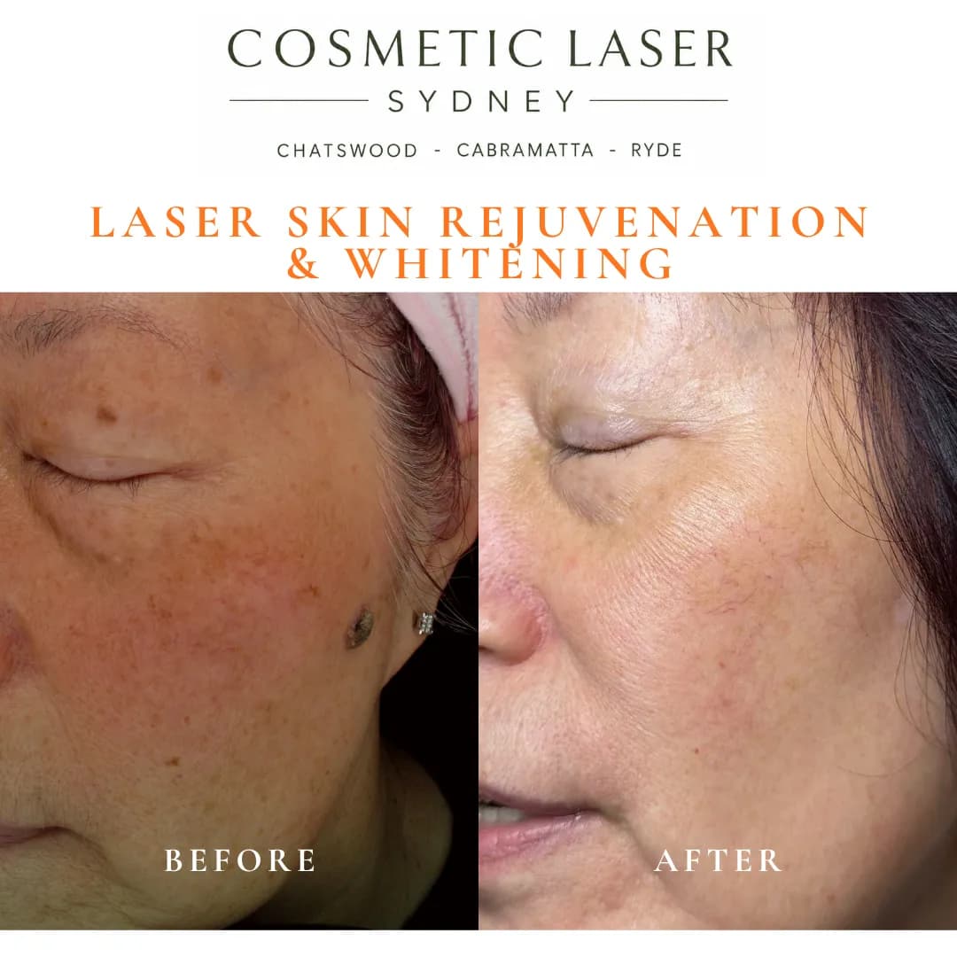 Before and after laser treatment of sun spots and age-related pigmentation