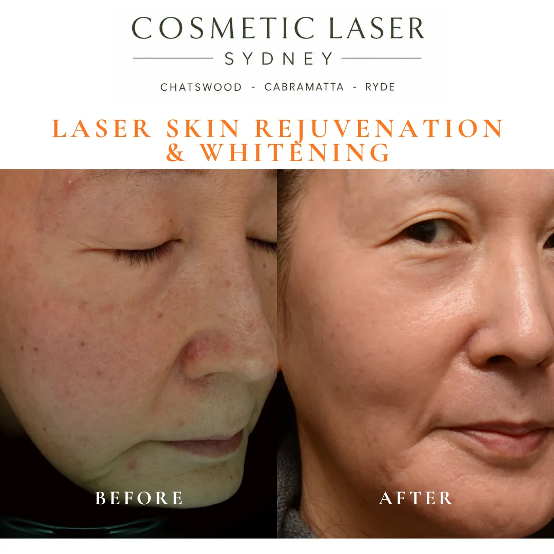 Before and after laser skin whitening and rejuvenation by Dr Peter Kim