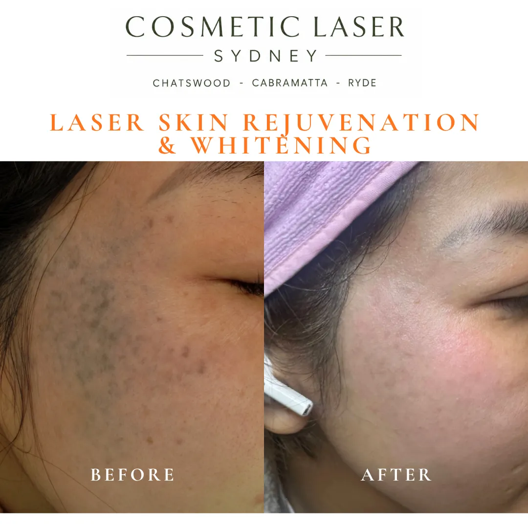 Before and after laser treatment of a pigmented birthmark