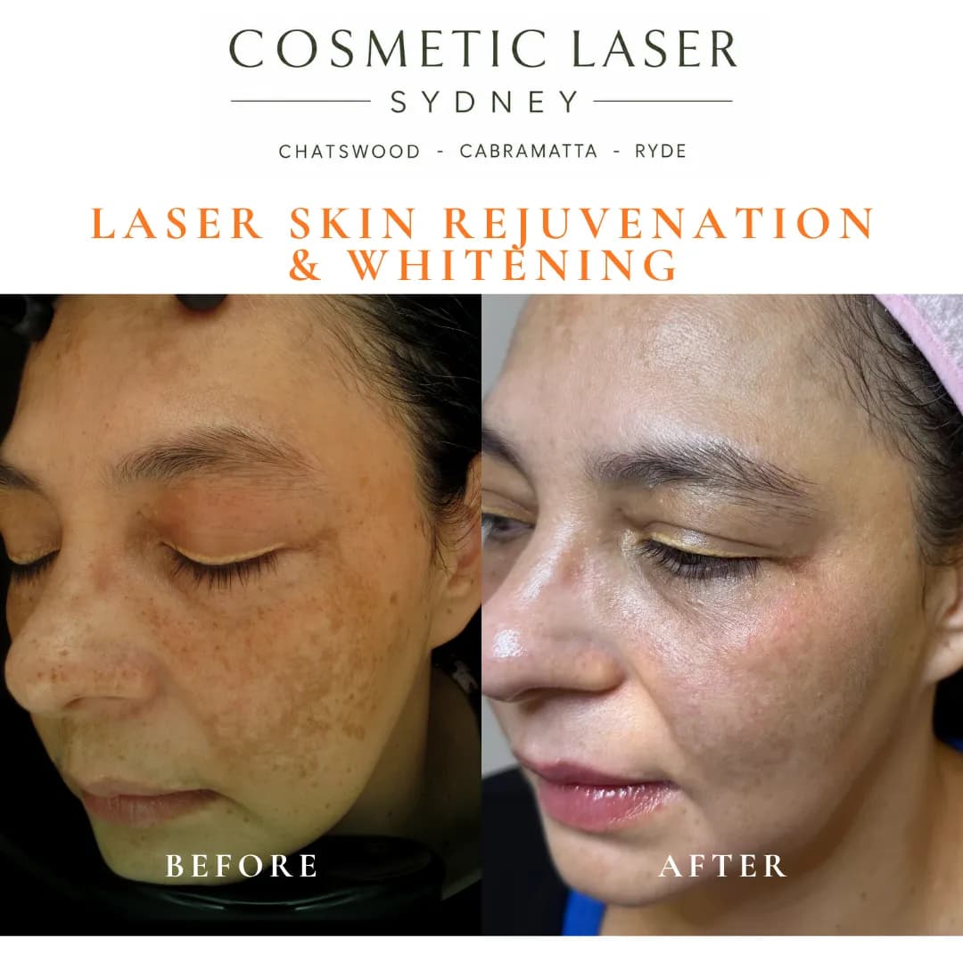 Before and after laser melasma, freckle and pigmentation treatment by Dr Peter Kim