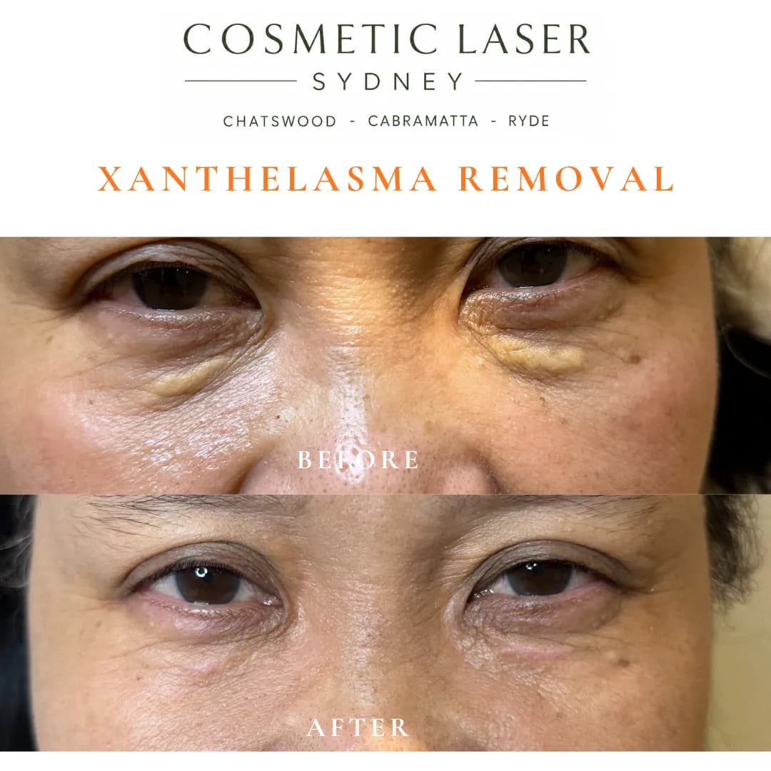 Before and after laser xanthelasma removal by Dr Peter Kim at Cosmetic Laser Sydney