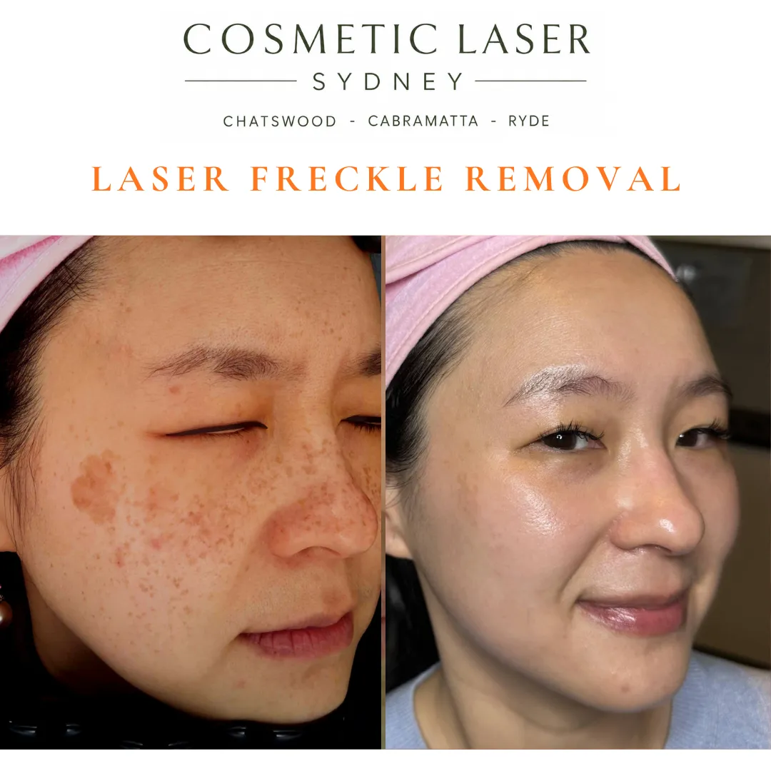 Before and after laser freckle removal