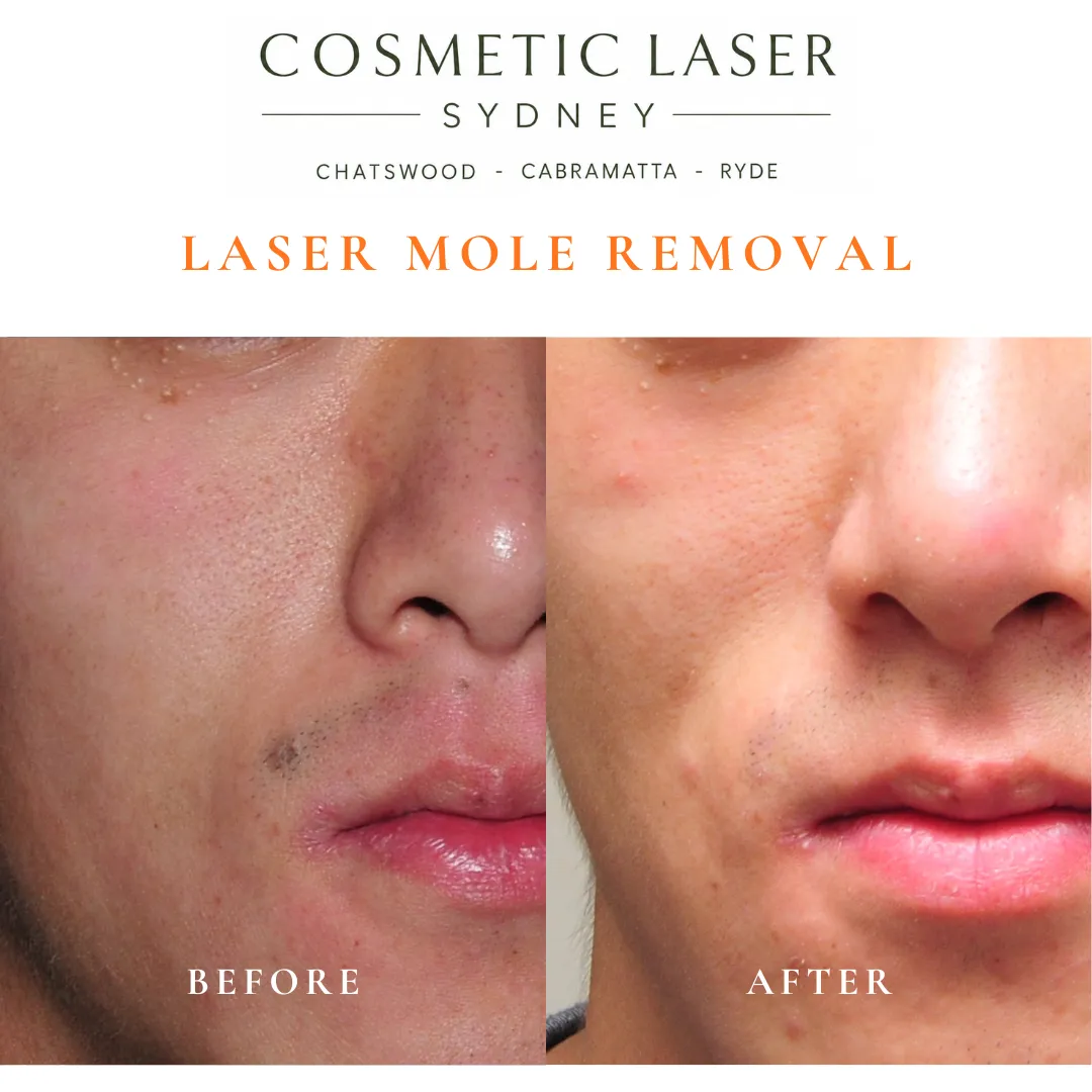 A mole on the upper lip removed with laser mole removal, taking care to minimise the risk of scarring