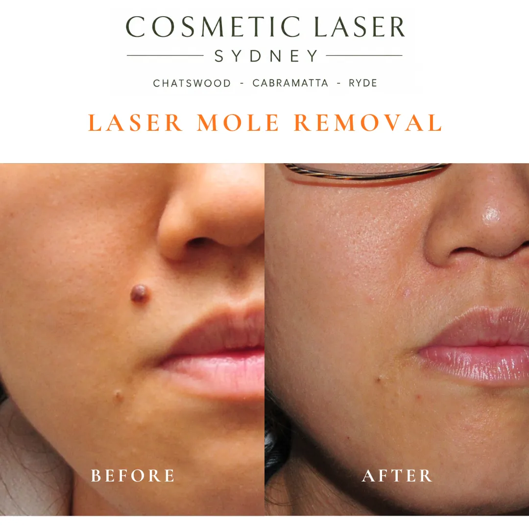 Upper lip mole treated with laser mole removal
