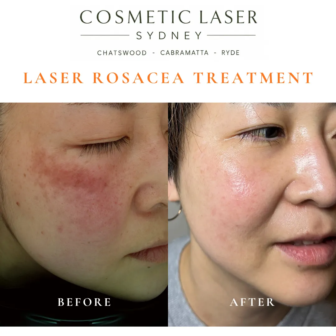 Before and after vascular laser treatment of facial redness