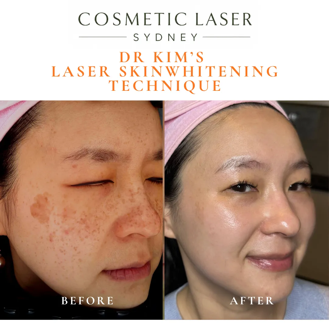 Before and after laser skin rejuvenation for Asian skin using Dr Peter Kim's Laser Skin Whitening Technique